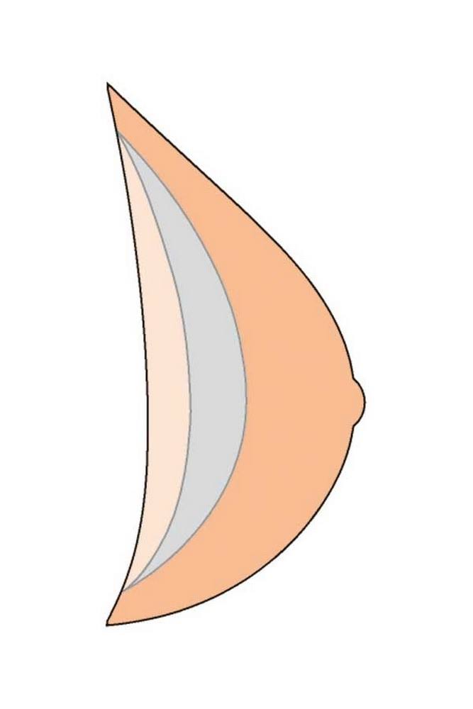 Natura Light 3S Breast Form Size 12 Z704891